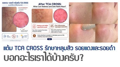 แต้ม TCA CROSS รักษาหลุมสิว รอยแดงและรอยดำ บอกอะไรเราได้บ้างครับ?